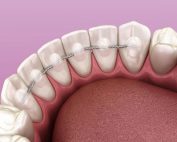 broken-bonded-retainer