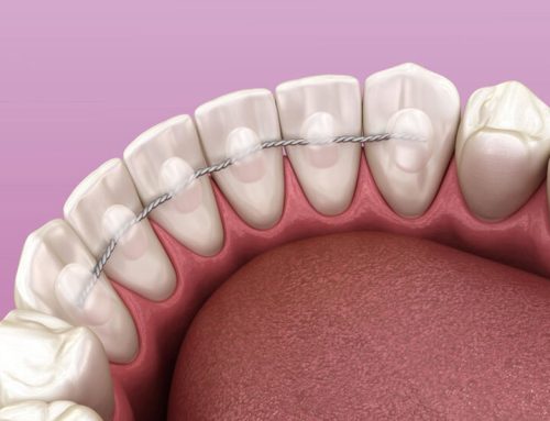 Orthodontic Emergencies In Hurghada : Broken Bonded Retainer