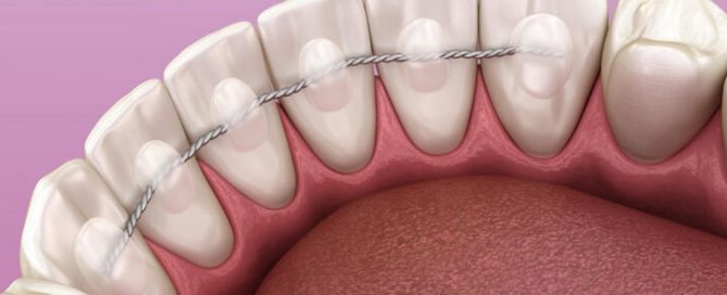 broken-bonded-retainer