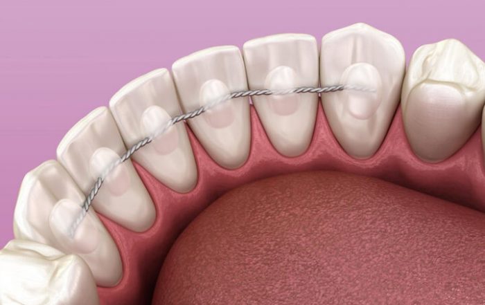 broken-bonded-retainer