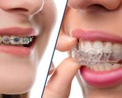 clear aligners vs. metal braces