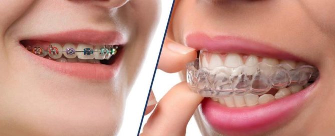 clear aligners vs. metal braces