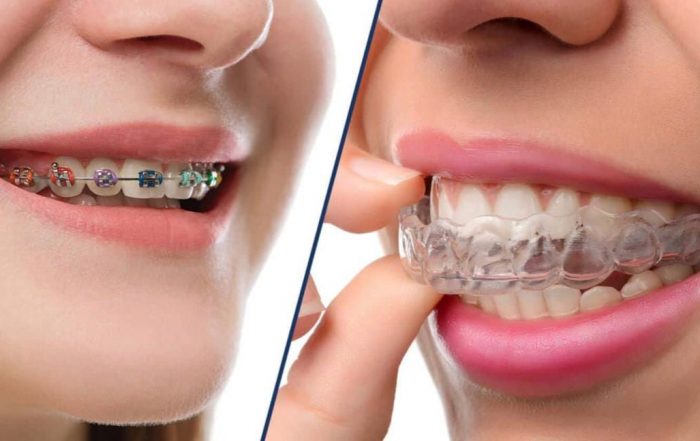 clear aligners vs. metal braces