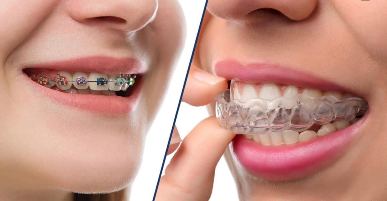 clear aligners vs. metal braces