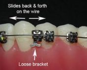 Orthodontic Emergencies – What to Do If You Have a Loose Bracket