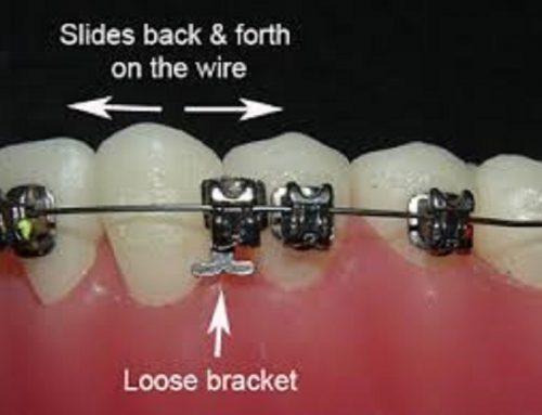 Orthodontic Emergencies: How To Deal With a Loose Bracket