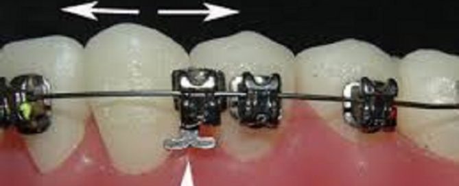 Orthodontic Emergencies – What to Do If You Have a Loose Bracket