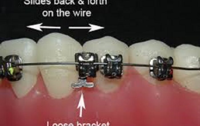 Orthodontic Emergencies – What to Do If You Have a Loose Bracket
