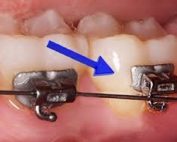 loose orthodontic wire