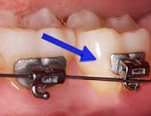 Orthodontic Emergencies: Losing Module or Having Loose Wire