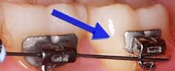 loose orthodontic wire