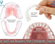 Clear and Fixed Retainers After Orthodontic Treatment