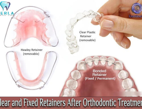 Clear and Fixed Retainers After Orthodontic Treatment