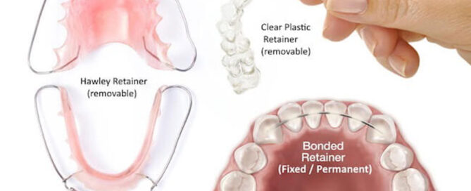 Clear and Fixed Retainers After Orthodontic Treatment