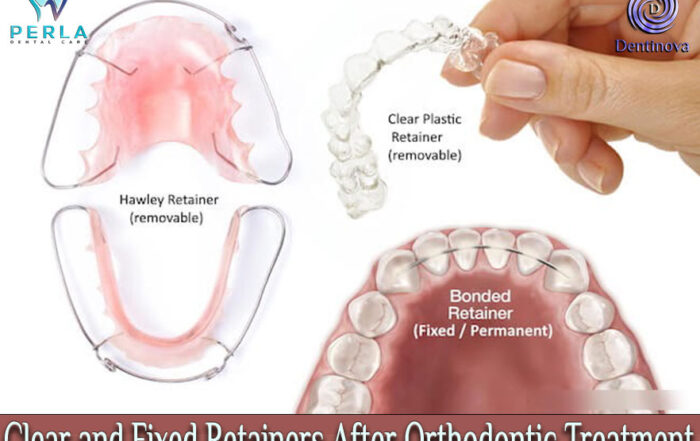 Clear and Fixed Retainers After Orthodontic Treatment