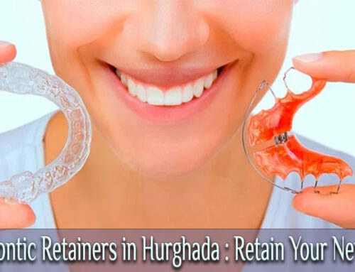 Orthodontic Retainers in Hurghada : Retain Your New Smile
